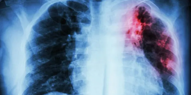 Confirmaron casos de tuberculosis en General Villegas